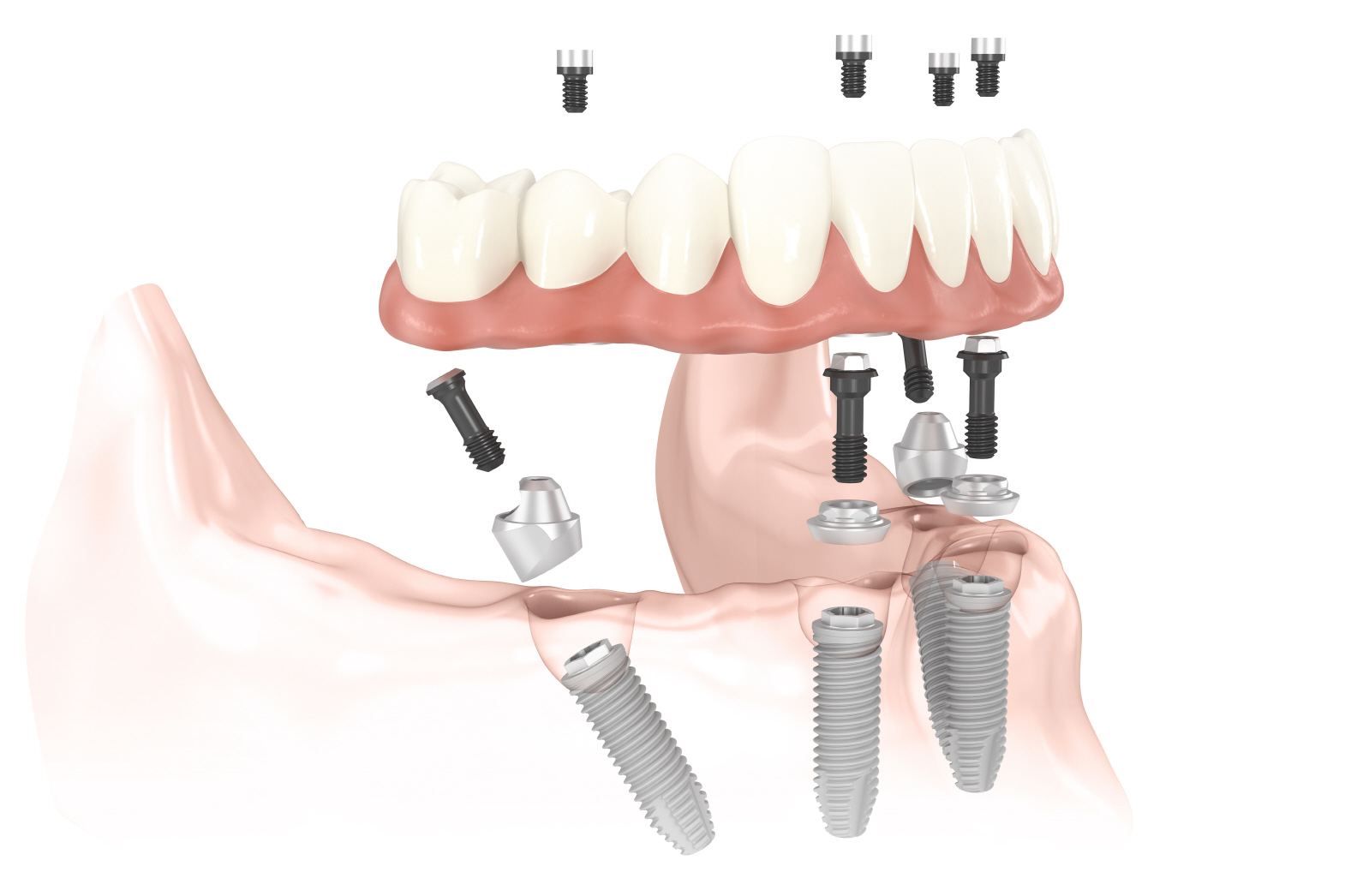 Demostracin de prtesis dentales